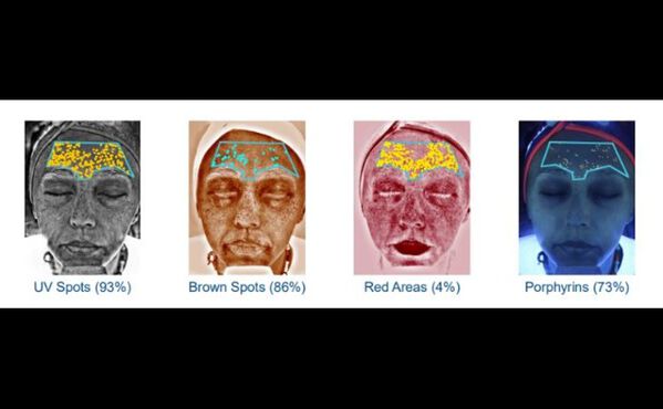 Skin analysis images for beauty editor Shannon Peter, showing UV spots, brown spots, red areas and porphyrins.